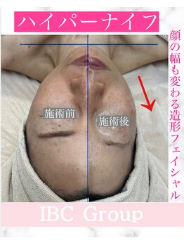 トータルサロンアイビーシー(トータルサロンIBC)/ハイパーナイフ小顔フェイシャル