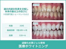 クレア(Crea)/【歯のホワイトニング症例写真】