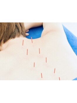 鍼灸施術を受けたい