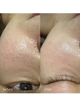 リメレ(Rimere)/毛穴ケア