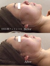 ボディベルム(BODY BELM)/小顔フェイシャル