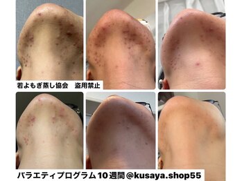 エフブンノイチ(1/f.)/生理前ニキビ