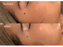 リスタ(RSTA)/【BEFORE/AFTER】