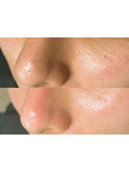 毛穴ケアをしたい