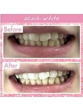 エクシアホワイトニング 中野駅北口店/ホワイトニングビフォーアフター
