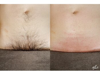 ムート(Mut.)の写真/【ヒゲ・VIOはサロンケアが確実】仕事中やサウナ・ジムなどプライベートも快適に過ごせる脱毛習慣◎