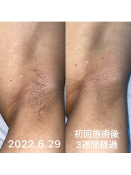 アシヤ髭ラボ(ASHIYA 髭 LABO)/ワキ脱毛ビフォーアフター