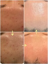 アストリア(ASTORIA)/TIPハーブピーリング