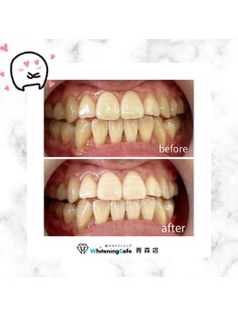 ホワイトニングカフェ 青森店/★お客様の変化