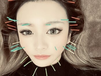 フラット(flat)/小顔美容鍼で即効リフトアップ