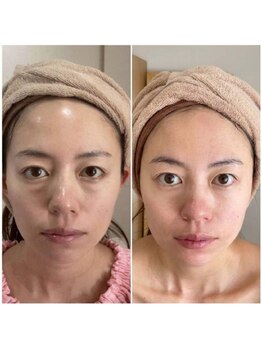 カブール 町田/目元のたるみケアにバイオセル