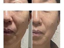 メディカルサロン かとれあ/ADSプログラム3カ月