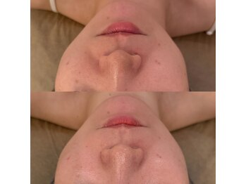 ラドンナ(LA DONNA)/ほうれい線・フェイスライ左右左