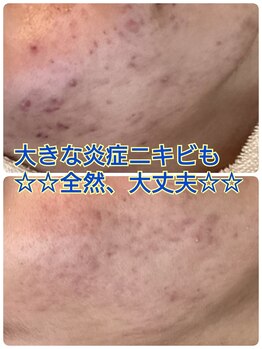 キッカ 梅田天六(Kikka)/メンズの繰り返すニキビも◎