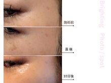 ドアディ(Doordie)/Brightingフォト　しみケア 