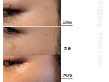 ドアディ(Doordie)/Brightingフォト　しみケア 