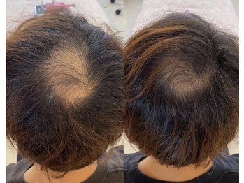 カナエル ビューティーサロン(Canael Beauty salon)/プロセルセラピーズ 1回