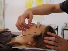 こと鍼灸院・整骨院/リフトアップも