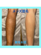 ラ シルク(La silk)/メンズ脱毛