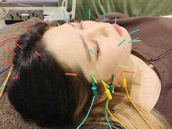 フラット(flat)/小顔美容鍼で即効リフトアップ