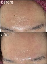 毛穴塾/ハイドラ毛穴洗浄