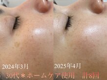 サロンドフルール/シミポイントケア