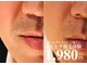 メンズ エステティック ヒーロー(men's esthetic HERO)の写真