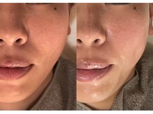 リスタ(RSTA)/【BEFORE/AFTER】