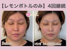 アンリエッタ(Unlieta)/お顔のダイエットにも◎