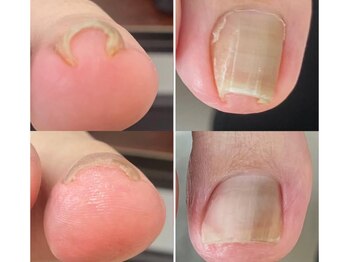 巻き爪補正Before/After