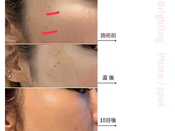 ドアディ(Doordie)/Brightingフォト　しみケア 