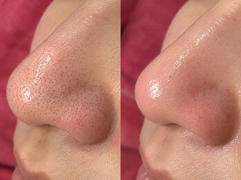 ティエル 高崎店(Tiele)の写真/何をしても気になる黒ずみ・角栓・ザラつきに。毛穴の奥から徹底洗浄!