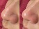 ティエル 高崎店(Tiele)の写真/何をしても気になる黒ずみ・角栓・ザラつきに。毛穴の奥から徹底洗浄!