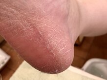 ネイルサロンアンドスクール シーグリーン(SEAGREEN)/【お悩み事例】かかとのかさつき