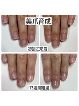 マニュコクーン(ManuCocoon)/爪育成　深爪　巻き爪　大阪市