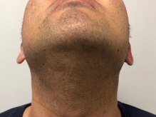 リル(RILU)/【脱毛】ヒゲ(before)