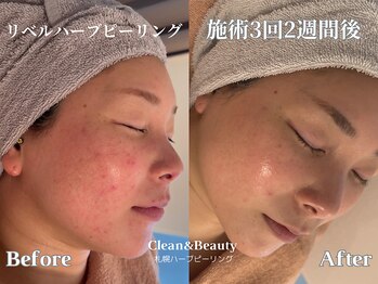 クリーンアンドビューティ 札幌(Clean&Beauty)/札幌リベルハーブピーリング♪