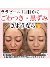 ホワイトアクア 梅田本店(WHITE AQUA)/ハーブピーリング/大阪/梅田