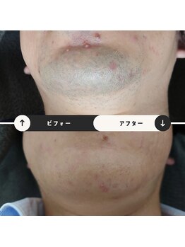 ジュゴン(Dugong)/ヒゲ脱毛（Before＆After）