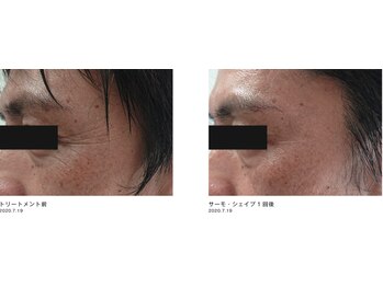 Nビューティー/最新RFサーモシェイプオーパス