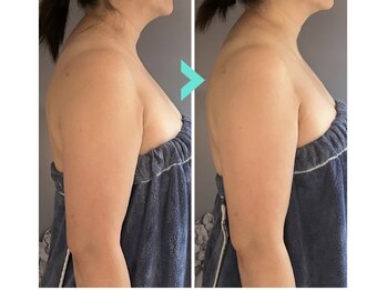 ミルキー(Milky)/超音波ｘＲＦで確実にスッキリ