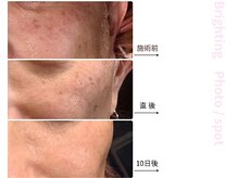 ドアディ(Doordie)/Brightingフォト　しみケア 