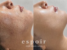 エスポア(espoir)
