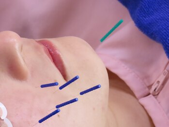 飯田橋駅前鍼灸整骨院/美容鍼【飯田橋/鍼灸】