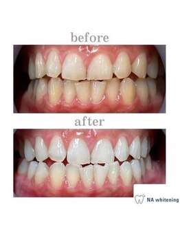 NA ホワイトニング 川崎溝の口店/ホワイトニング/川崎/溝の口