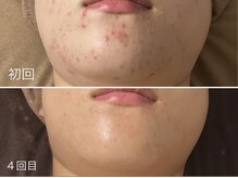 エイプリルフールズ(April fools)/【20代】ニキビケアで美肌へ！