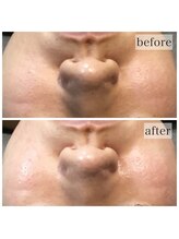 アウラ(AURA)/ダクトピール before/after