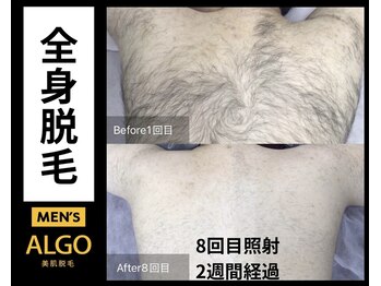 アルゴ 山口店(ALGO)/メンズ脱毛