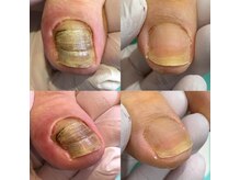 巻き爪補正店 和 光市店の雰囲気（分厚いへ変形爪施術のビフォーアフター）