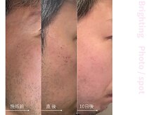 ドアディ(Doordie)/Brightingフォト　しみケア 